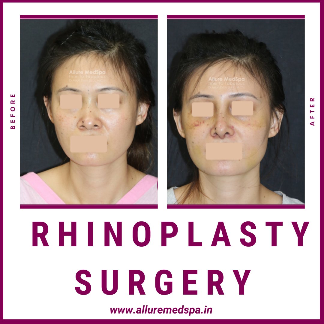 “Another successful Rhinoplasty session. Before and After. What do you think of the transformation?”⠀
#rhinoplastymumbai  #rhinoplastyexpert  #rhinoplastysurgeon  #alluremedspaindia #drmilandoshi #plasticsurgery #noseshape   #cosmeticsurgery #boardcertifiedplasticsurgeon