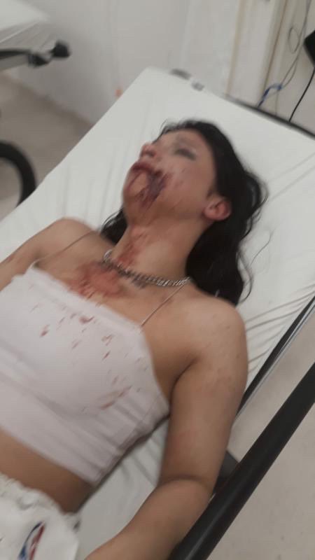 muhendisyenn's tweet photo. Dün Harbiye’de saldırıya uğradı Trans kadın Beren Ecmel. Sözlü taciz bir zaman sonra fiziksel şiddete döndü. Yüzünü kesen suçlular ise kayıp!

#transfobiöldürür https://t.co/86dklvN0vD
