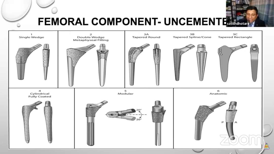 drhiteshg's tweet photo. https://t.co/6yhZx9nmP6 Biomechanics of THR
#orthotwitter #medtwitter #frcsorth #fracs #frcsc #oite #abos #dnborth #msorth https://t.co/52n9TAwUb1