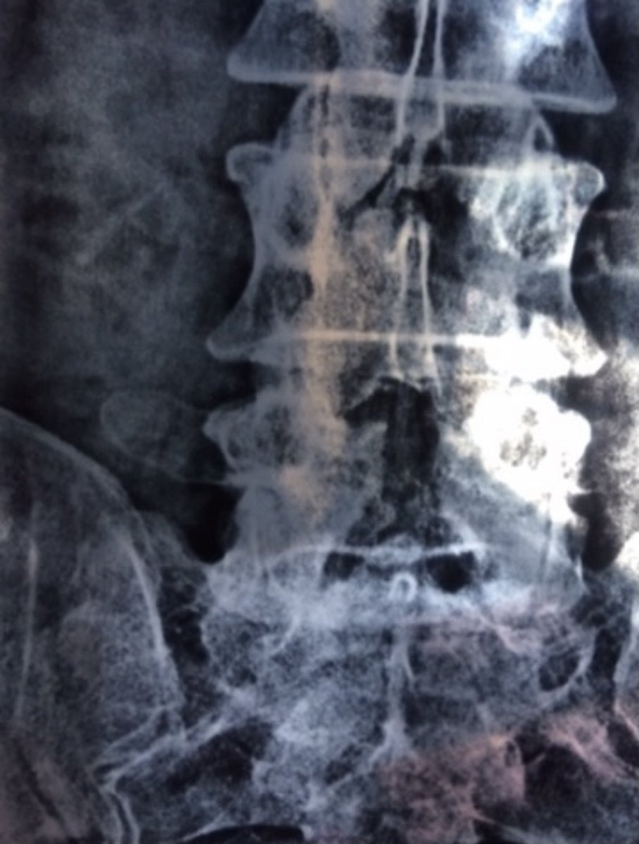 tariqtramboo's tweet photo. Small Lab, animals, Cadavers, Me & My friend Dr Ash ——— Made #Spineloop possible. Path breaking technology that will make spine surgeries extremely safe and incision free. With multiple international patents we are in command & will attract patients from all over the world. #Pain https://t.co/8dJcRu4z48