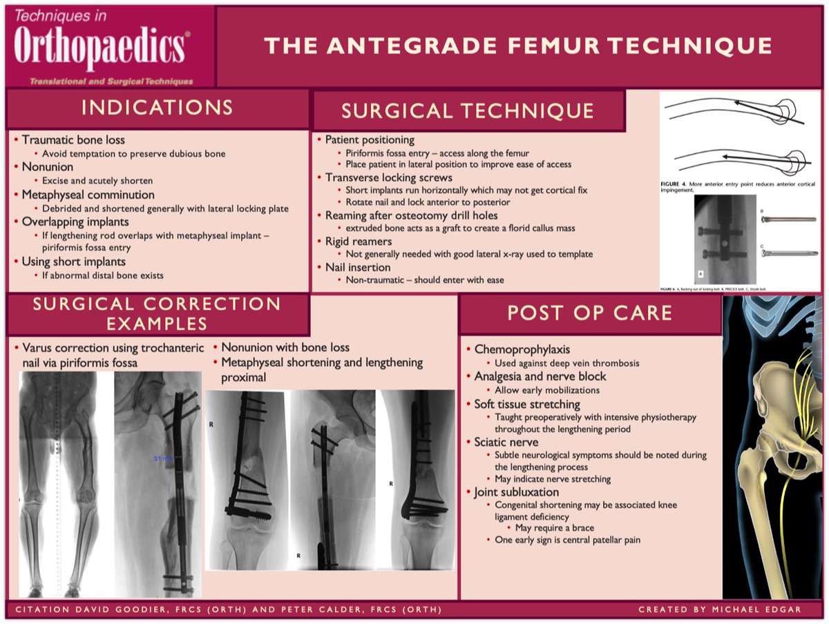Our latest #VisualAbstract is out! "The Antegrade Femur Technique"

#Orthopedics #orthotwitter #orthopaedics #orthopedicsurgery