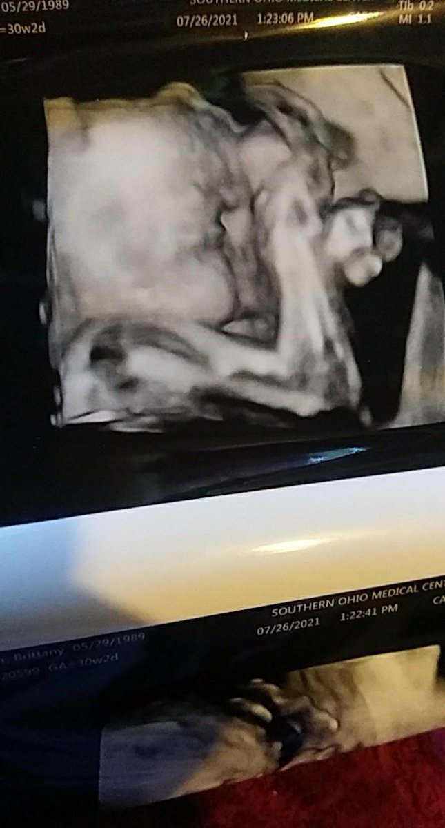 BrittanyDoerfl2's tweet photo. Princess was not happy today and didnt wanna move her arm from in front on her face. But measuring 3lbs 10 oz and all looks good #30weeks2days https://t.co/T1oDKqteeF