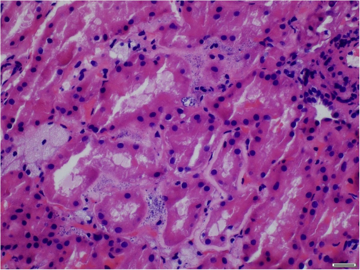 ASPNeph's tweet image. Phosphate Nephropathy in #GitelmanSyndrome @KidneyMed  #openaccess
ow.ly/V9Su50FDg7b