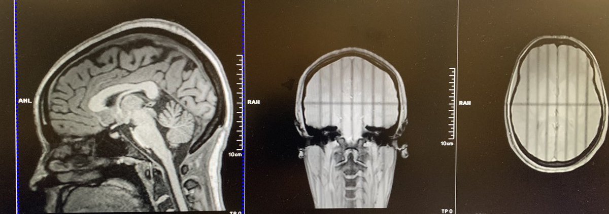 I love this so much!!! 🥳 hello everyone! My name is Jocelyn Ricard and I am a post bacc research assistant at @Yale University. I’m interested in neuroimaging and substance use/addiction proudly first gen and yes that is my brain!!! 🥺#BINW21 @BlackInNeuro #BlackInNeuroRollCall