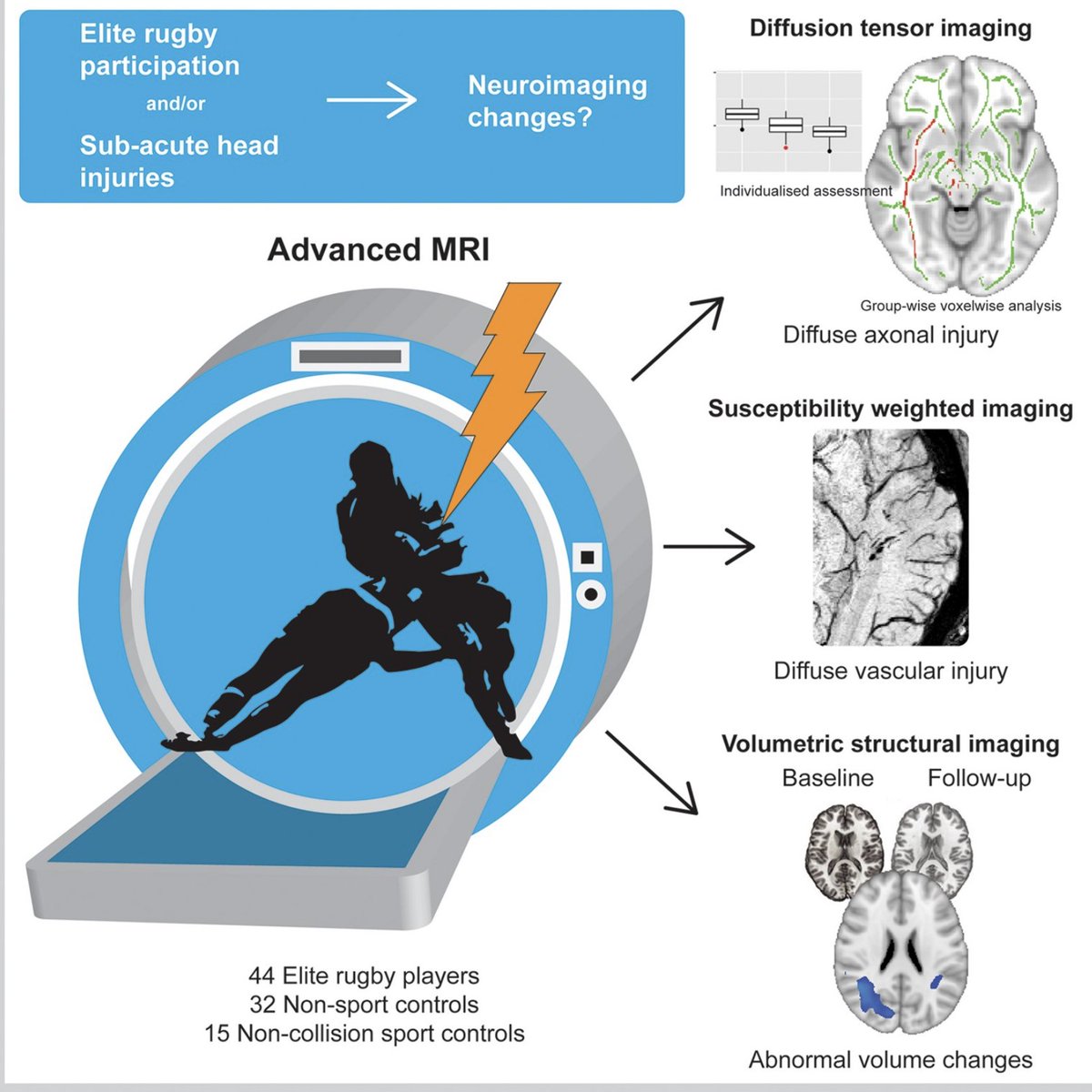 1/ Almost a quarter of elite adult rugby players have brain structure abnormalities as a result of repeated head impacts, research finds