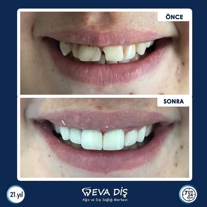 devadisadsm's tweet photo. Hastamıza gingivektomi yapılarak diş eti seviyesi düzenlendi ve ön 6 üye zirkonyum kaplama ile estetik gülüş tasarımı yapıldı.
#zirkonyumkron
#zirkonyumdiş
#zirkonyumkaplama
#gingivektomi
#estetikgülüş
#estetikdişhekimliği https://t.co/WylDKRPJB9