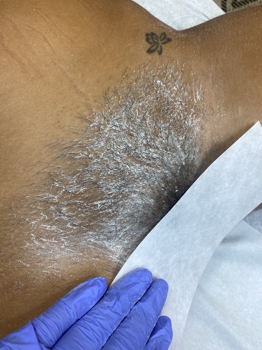 Cloud9aesthetic's tweet photo. Got my Girl Beach Ready!
Full Brazilian = No Hair Left Behind ( includes butt strip)
Hard Wax all the way.
I estimate all clients come back between 4-5 weeks
https://t.co/UPv6ZuBVmi
#wax #atlwax #atlantawaxing #atlesthetician #atlspa #waxatlanta https://t.co/NTm3quo3ZB
