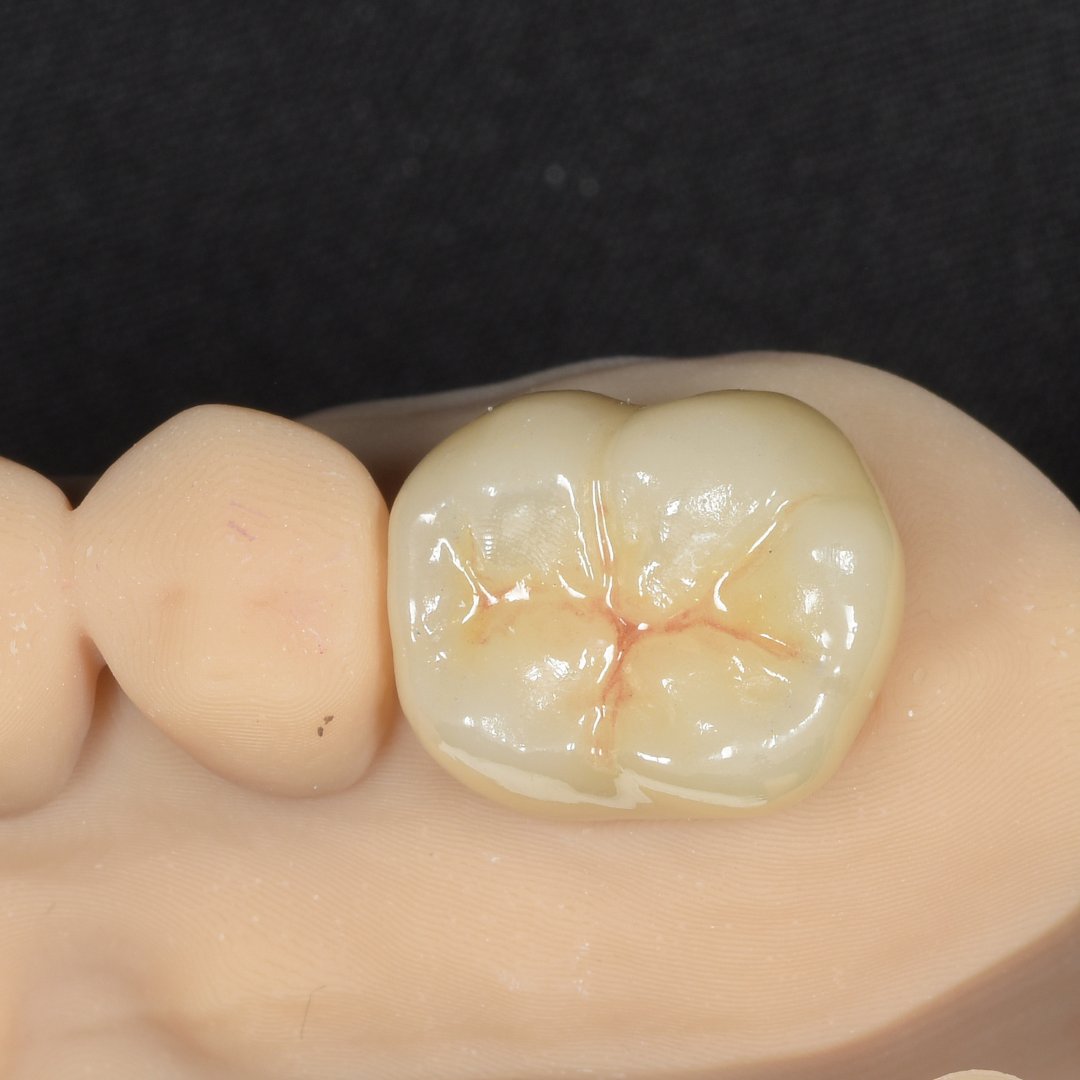 kanamorisika's tweet photo. #trios3
#intraoralscanner
#dentist#dentistry#ceramics#zirconia#ジルコニア⠀
#ceramicrestoration ⠀
#セラミック #dentist #dentistry ⠀
#歯科 #歯医者 #歯科医院 #ペリオ #歯周病専門医 #歯周病 ⠀
#品川 #品川区 #新馬場 ⠀
#かなもり歯科クリニック https://t.co/iqonhUNzde