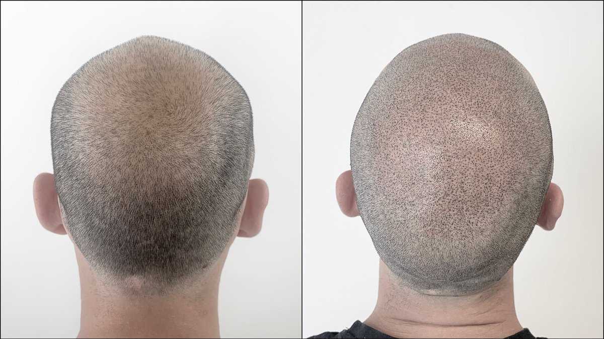 VincenzoConi's tweet image. Tricopigmentazione eseguita da Vincenzo Coni  presso lo studio Dermatrico Repair.
(Sardegna - Cagliari) (Lazio - Roma)

#Tricopigmentazione #Scalppigmentation #Tatuaggiocapelli  #Sardegna #Cagliari #Lazio #Roma #tricopigmentazionesardegnacagliari