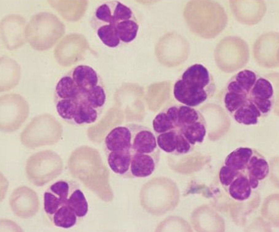 #idboardreview 50 Japanese male w/ 1 month of fatigue, generalized lymphadenopathy, wbc 90k w/60% of circulating atypical lymphocytes along with flower cells (lobulated nuclear configuration). dx? #medEd #idmeded #idtwitter