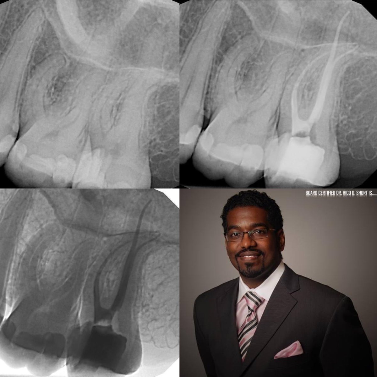 DrRicoShort's tweet photo. The SHORT BONUS Case Of The Day!
Tooth #15 -
I can make the magic come out of any file system! πͺπ§
Endodontic treatment was performed on tooth #15 in one visit using Brasseler USA #ScoutFiles. I really like these files. They are heat treated, very strong, and very flexible. https://t.co/JSFy12Nnzf