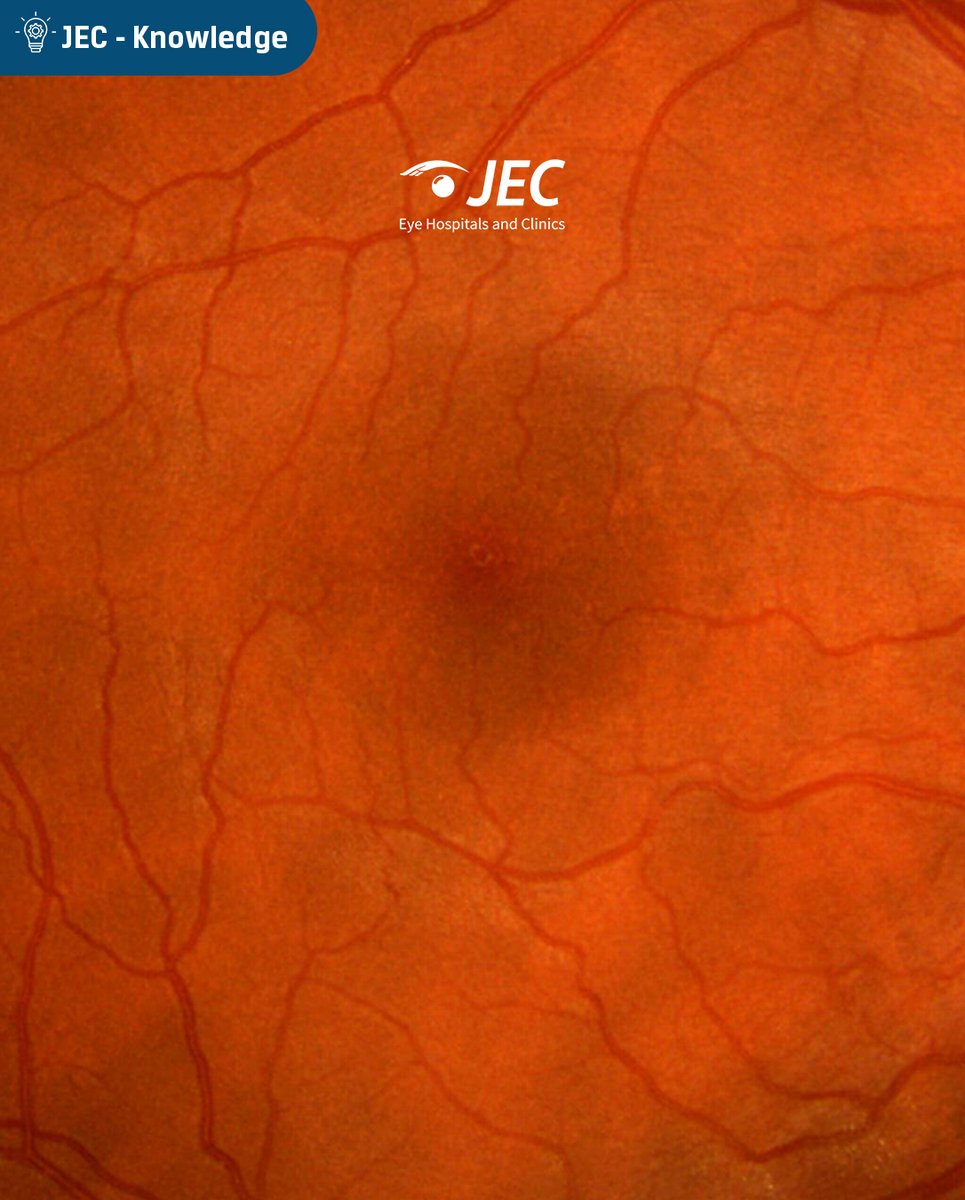 JECEyeHospital's tweet photo. Retina merupakan bagian penting mata yang berperan besar terhadap kemampuan manusia dalam melihat. Oleh karena itu, ketika retina mengalami kerusakan, kemampuan untuk melihat juga akan mengalami gangguan dan berpotensi terjadi kebutaan permanen!
#JEC #Retina #JECKnowledge https://t.co/paOO3Fr3V3