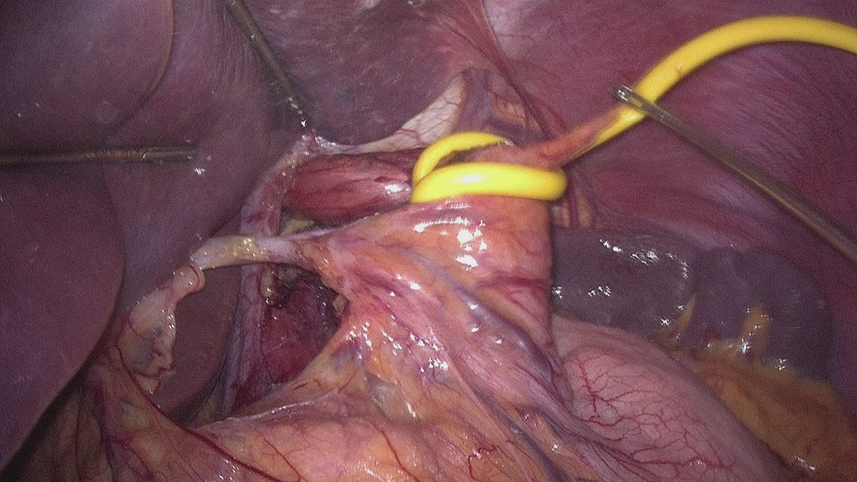 drenriquearias's tweet photo. #3DvisionSurgery and #MiniLap
#NissenFundoplication preserving an accessory hepatic artery
@SAGES_Updates @Some4SurgeryIT1 @me4_so @cirugiaespanola @AsociacinSalva1 @AmCollSurgeons https://t.co/V1i19oLslY