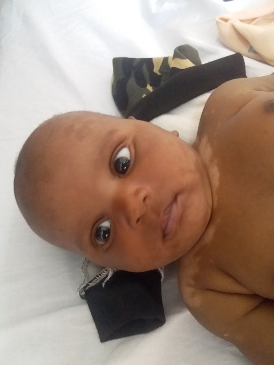 Paed Clinics of Dar, Tanzania, (Nicholas and Ronald): 
#Vitiligo: Common, acquired, chronic disorder of pigmentation. 
Clinical features: depigmented well defined macules on the skin and patches, milk or chalkwhite in colour. 
Treatment: Topical, Systemic, photothetapy.