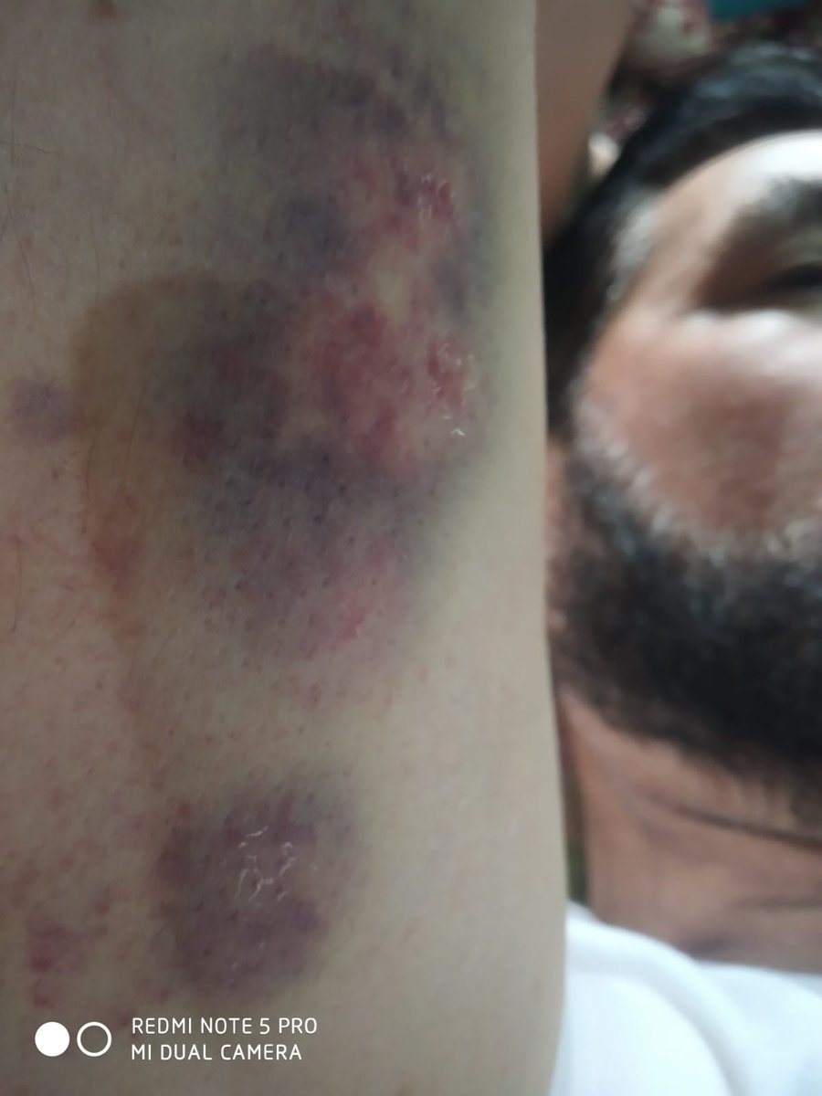 Masratzahra's tweet photo. Posting the picture of my father who was thrashed by police. One can clearly see his bruised arm. I didn't want to post these pictures but yesterday's police statement is ridiculous and they cannot thrash people in the day and at the end of day when questioned deny the thrashing. https://t.co/TM6wzEXUdO