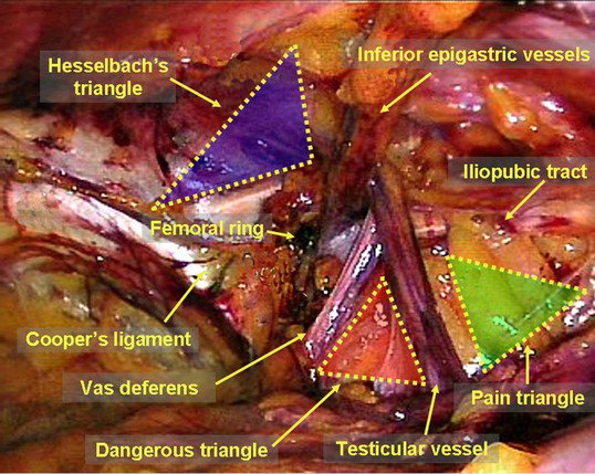 DrJonnys's tweet photo. Anatomy essentials for laparoscopic inguinal hernia repair.
#SoMe4IQLatAm #SoMe4Surgery #medtwitter

https://t.co/AgA2mupTPm https://t.co/ldz7JAQkFr