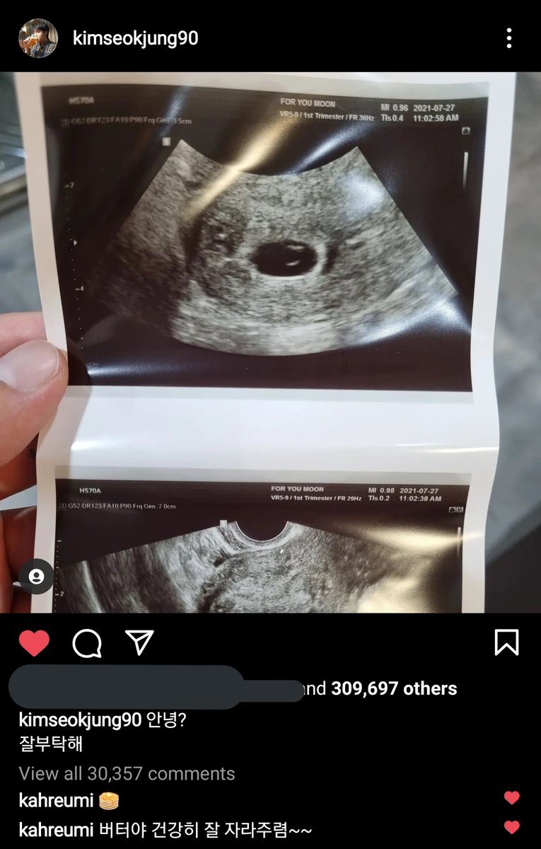 BTSNewsBrasil's tweet photo. 📍 Hoje o Seokjung, irmão do Jin, compartilhou em seu Instagram uma ultrassom e tudo indica que ele vai ser Papai!!

Ele e a esposa não divulgaram muitos detalhes.
Desejamos toda felicidade do mundo para a família.

Vem aí Tio Jin 💜 https://t.co/N5G4iWZU0v
