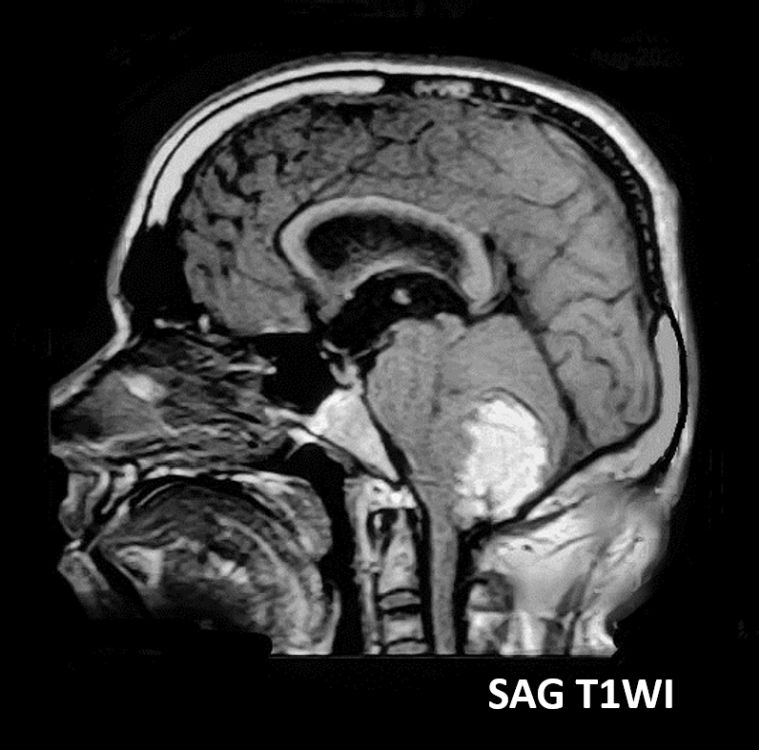 #AJNRcc >> July 26, 2021 >> What is the diagnosis for this 37-year-old nonhypertensive man with headache and ataxia? Submit your answer at ow.ly/oUvT50FEyot.