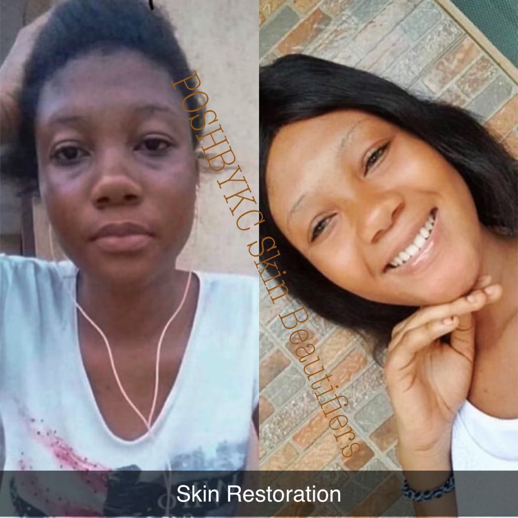 kcbatte's tweet photo. Desiring Balanced Natural Skin Light @poshbykc_skinbeautifiers Flawless Spotless Beautiful Glowing Skin. Guarantee 3Days Natural Glow Fast Results . 📞 WhatsApp 0794701570 https://t.co/VDfKNvml5I