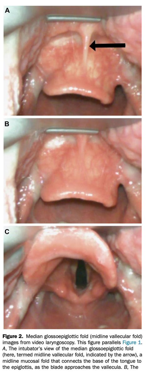 Nick Mark MD (@nickmmark) on Twitter photo Very useful airway trick: engage the tip of the laryngoscope in the vallecula & use the median glossoepiglottic fold to raise the epiglottis. This often improves your view of the vocal cords.
Nice review of this maneuver in <a href="/AnnalsofEM/">AnnalsofEM</a> by @airwaycam <a href="/brian_driver/">Brian Driver</a> <a href="/ErinKarl_MD/">Erin Karl, MD, MEHP</a> Very useful airway trick: engage the tip of the laryngoscope in the vallecula & use the median glossoepiglottic fold to raise the epiglottis. This often improves your view of the vocal cords.
Nice review of this maneuver in <a href="/AnnalsofEM/">AnnalsofEM</a> by @airwaycam <a href="/brian_driver/">Brian Driver</a> <a href="/ErinKarl_MD/">Erin Karl, MD, MEHP</a>