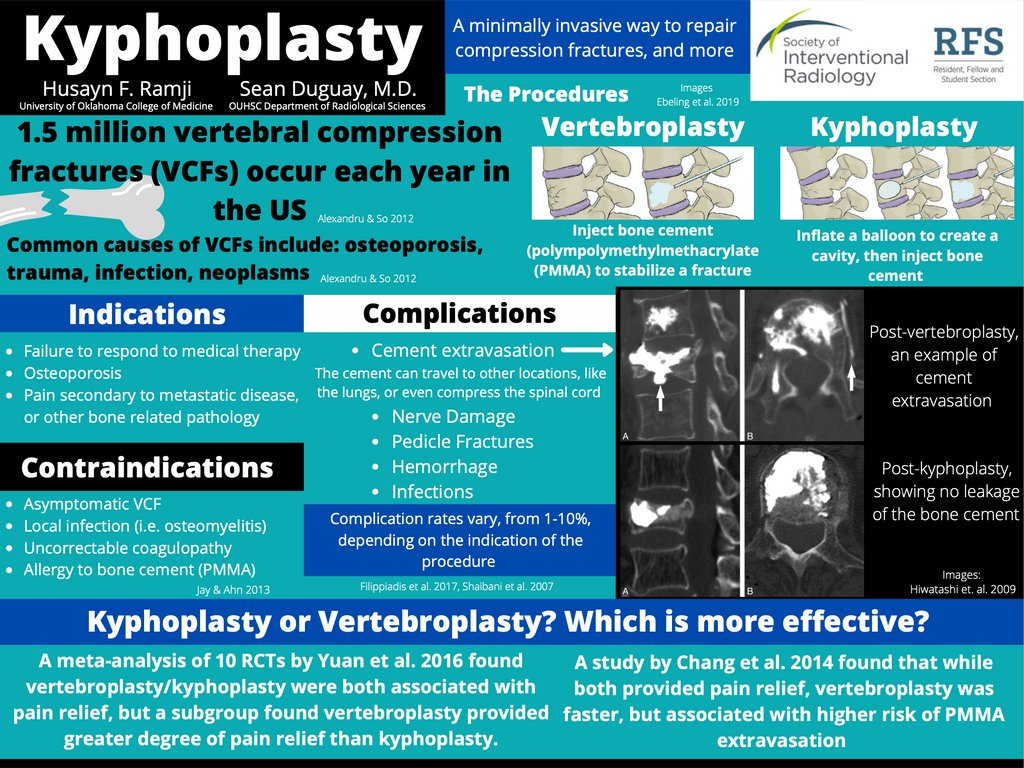SIRRFS's tweet photo. Check out this infographic on kyphoplasty created by SIR Med Student Reserves Member Husayn Ramji @husaynramji &amp; Dr. Sean Duguay @ouhealth_ir w/ assistance from the SIR MSC Education Committee. 
#MSCEdu21 #TwittIR #IRad #SIR #MedTwittIR #medtwitter #oucollegeofmedicine #ouhealth https://t.co/WWvP95zSV9