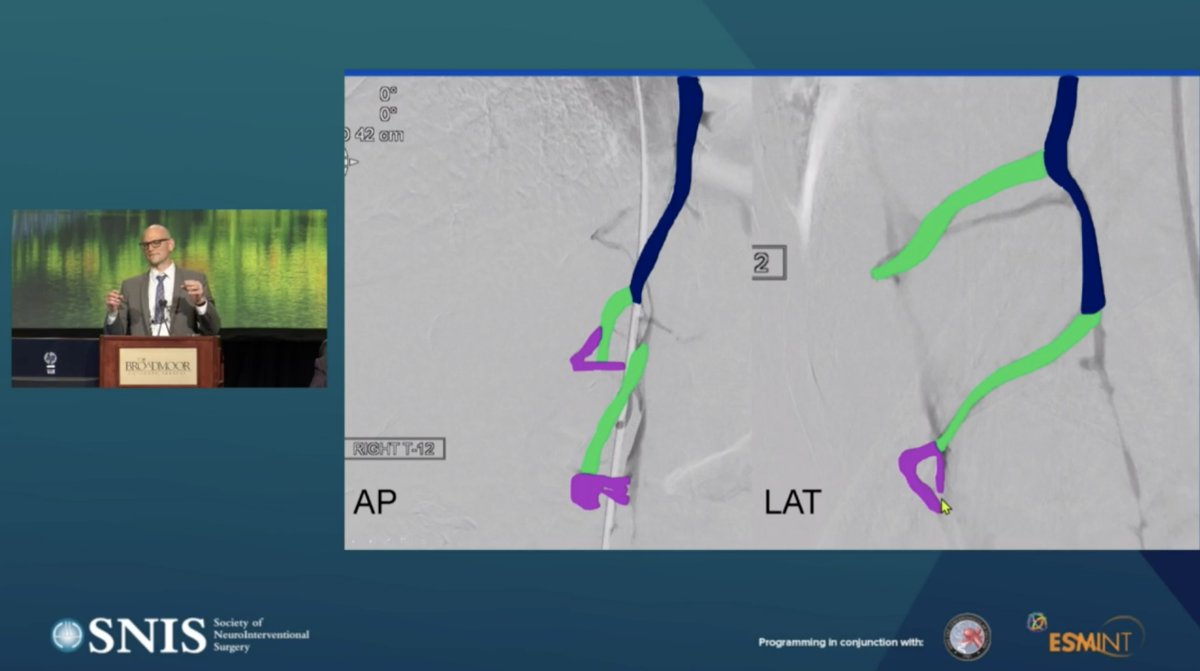 cvsection's tweet photo. @WBrinjikji talking about CSF-venous fistulas relevant #anatomy to a new means of #embolization #paraspinal vein #azygos vein #SNIS2021 @esmintsociety @svinsociety @JNIS_BMJ @MayoClinicNeuro https://t.co/y4Ecwtx34E