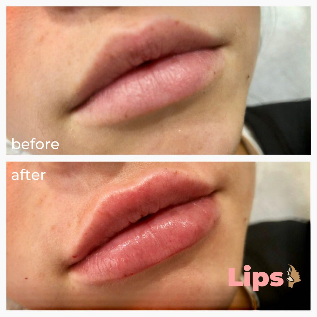 Sarivaa_uk's tweet photo. ✨Lips✨
We know sometimes all you need is a very small effort to achieve a big impact. Lips are a very important part of our face, as speaking draws the attention to them subconsciously.👄💋💄
🌐 https://t.co/NhvNMNKKFH
#LipsBotox #Botox #DermalFillers #Lips #BotoxBrighton https://t.co/zY3EWyfJQL