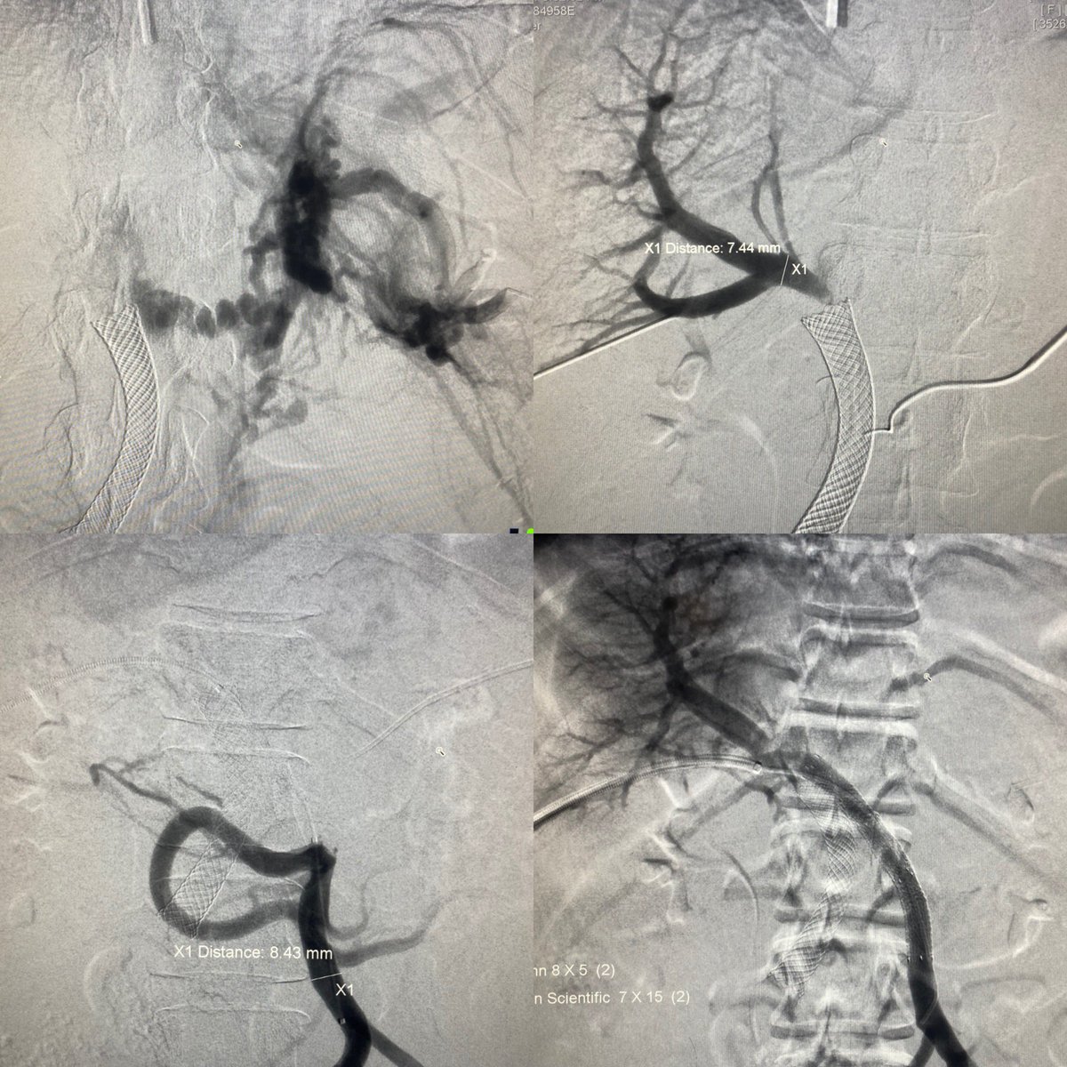 Sweet case from last few weeks. Malignant occlusion PV- splenomesenteric confluence. Treated with combo of stent grafts, sweat and BMS. Ascites, UGIB and encephalopathy better. #palliativecare #endovascular #Cancer <a href="/journalofgastro/">Journal of Gastroenterology Hepatobiliary Medicine</a> <a href="/SIRRFS/">SIR RFS</a> <a href="/ACRRFS/">ACR RFS - We've Moved! Follow @RadiologyACR.</a> <a href="/blakepparsons/">Blake Parsons</a> <a href="/Williamrilling7/">William</a>