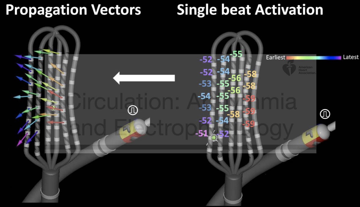 pzhong2016's tweet photo. View the electrical conduction by propagation vectors, which are created from unipolar waveforms of adjacent electrodes along and across splines that were acquired at single beats. https://t.co/YIm7YA5bIh https://t.co/981zuYNgkO