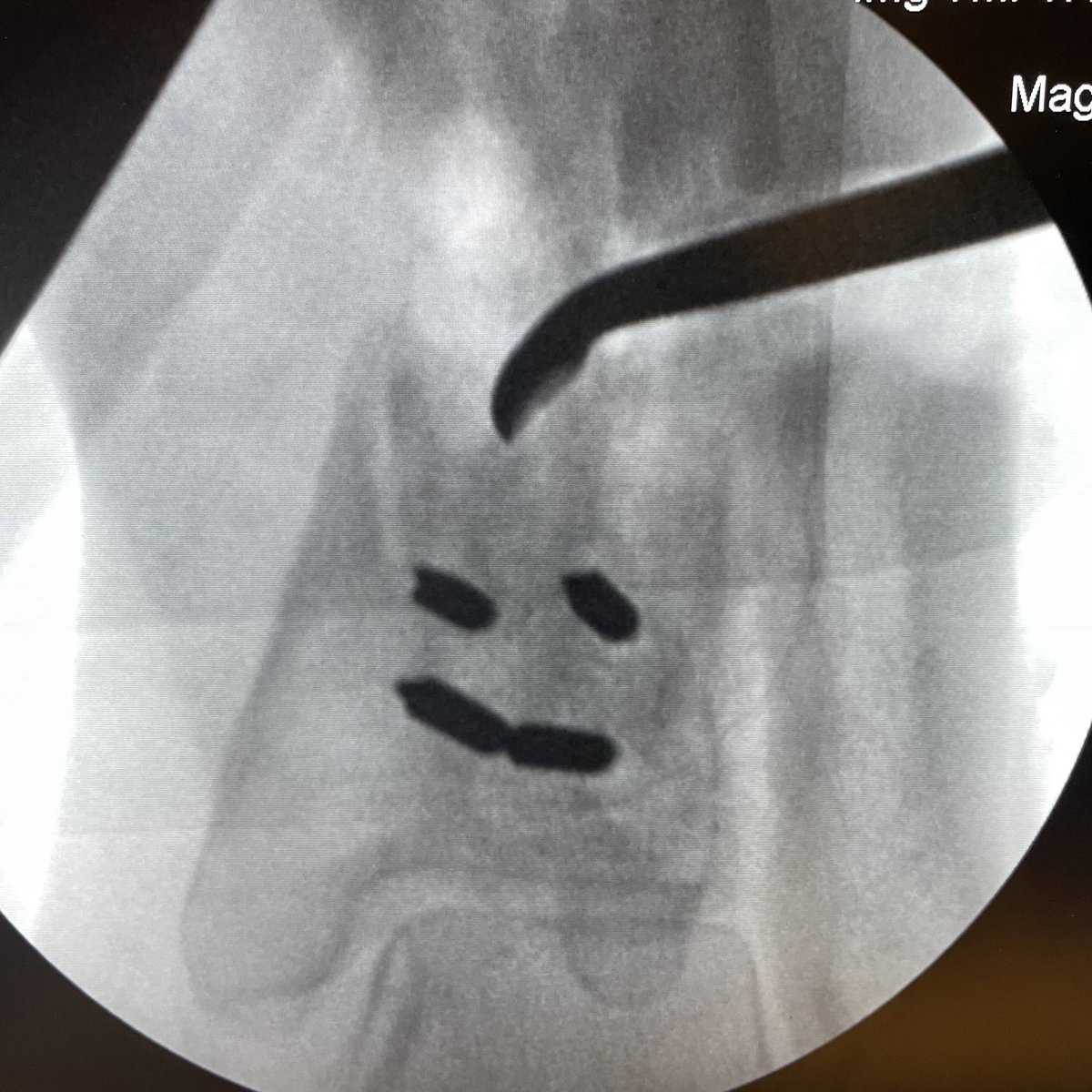 JanetConwayy's tweet image. Nonunion repair making me AND  this bone happy!!😂😂😊😊👍👍#orthotwitter #OTA #limblengthening #nonunion