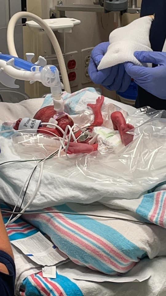 Dson1305's tweet image. I saw God today. 

Olivia Grace Deason 
1 pound and 1 ounce
7/27/21

And she’s the most beautiful thing we’ve ever laid our eyes on. To God Be The Glory. I can’t explain how much all the people who have prayed mean to us. It’s going to be a long road, but I’m pumped for the ride.