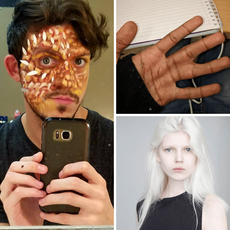 jaco_wacko's tweet photo. Have you ever heard of dermatographism? Heterochromia? 📈

These incredibly rare genetic mutations affect only 1 in several 1000 or million people across the entire globe 🌎

Even doctors weren't sure what to make of some of these 😱⛑️ #rare #genetics