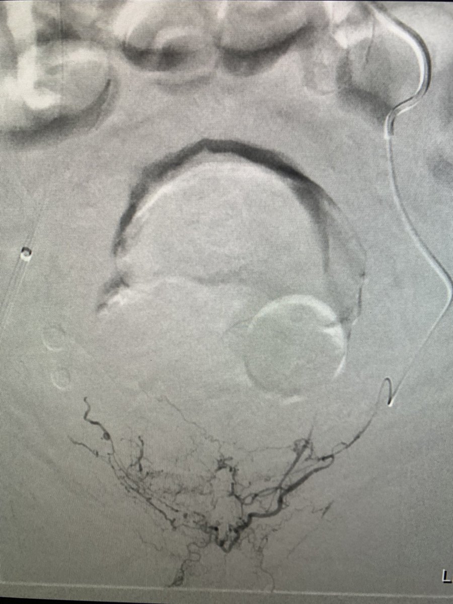 PAE! a)ipsolat oblique view showing “empty pelvis” on left b)obturator arising from ext iliac separate from inf epigastric (haven’t seen this before) c&amp;d) selectives of retropubic branch of obturator supplying base of prostate. <a href="/SIR_ECS/">SIR ECS</a> <a href="/SIRRFS/">SIR RFS</a> <a href="/IRAngioClub/">Interventional Angio Club</a>