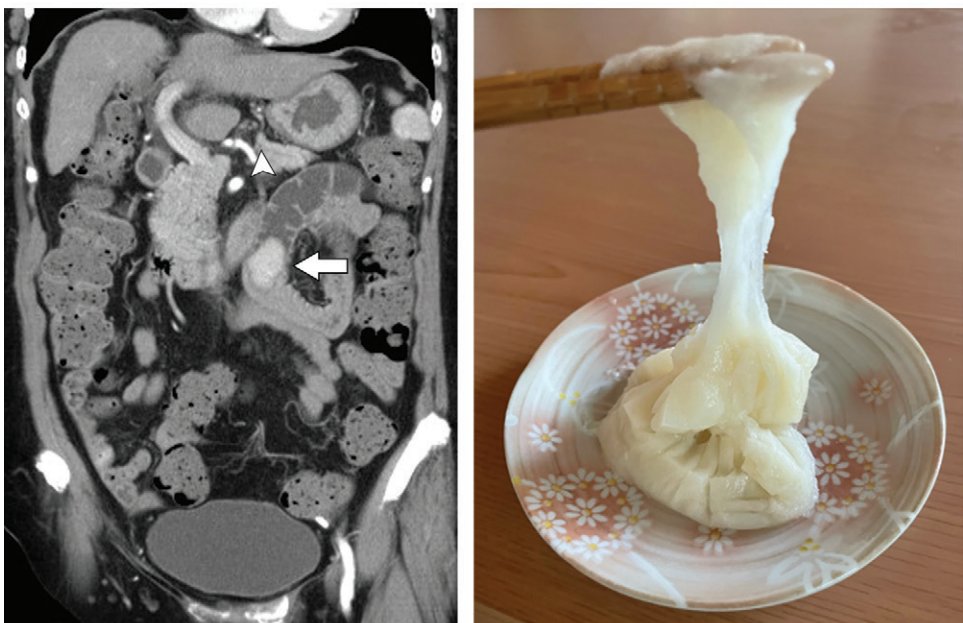 RadiologyEditor's tweet photo. Images in #RADIOLOGY:  Small bowel ileus on CT due to rice cakes - "mochi".  https://t.co/xxGc2KMVpZ https://t.co/umx4z2CJ0r