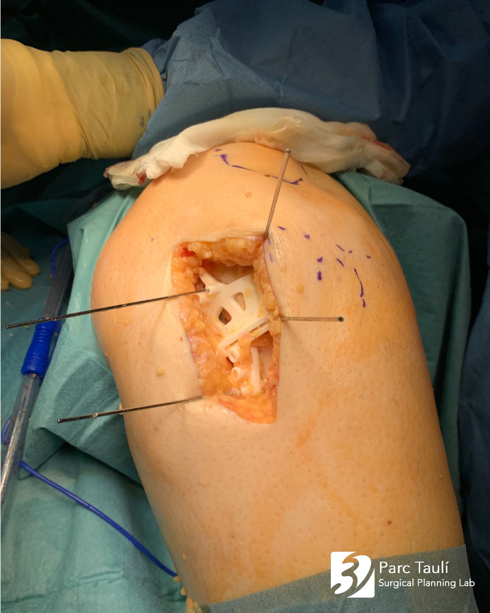 La osteotomía condilar tibial en valgo (OCTV) es un tipo de osteotomía tibial alta de apertura de cuña para la osteoartritis de la rodilla medial avanzada con articulación lateral subluxada.