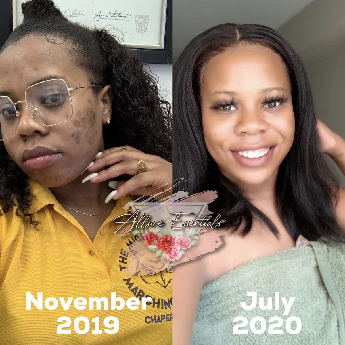 Patience is key. Our products are all natural we do not use chemicals and are for all skin types. 💖