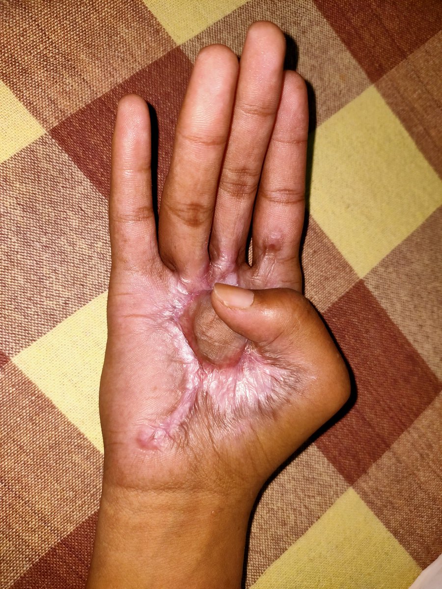 arunjeedi's tweet photo. Camphor burns. How often we see? Typically seen in rural India.
#burns #handburns #medtwitter https://t.co/yYkhNqcLgl