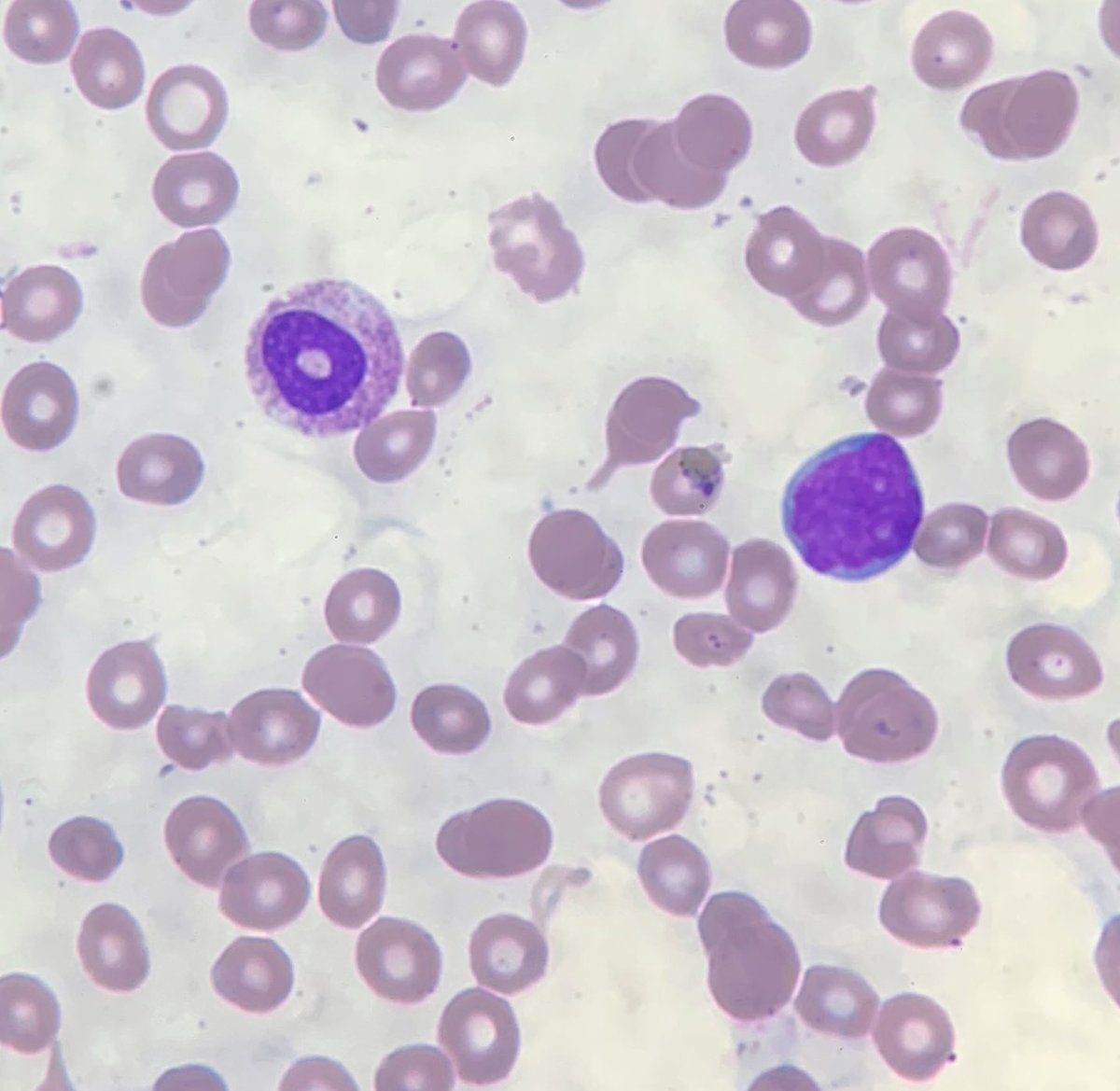MarrowandBlood's tweet photo. Another uncommon finding in a patient with new provisional diagnosis of AML with Maturation. See the blast and ring neutrophil. I rarely ever see ring or doughnut neutrophils. #hemepath #haempath #AML #bloodfilm #hematology #haematology https://t.co/PVKVG3CBFz