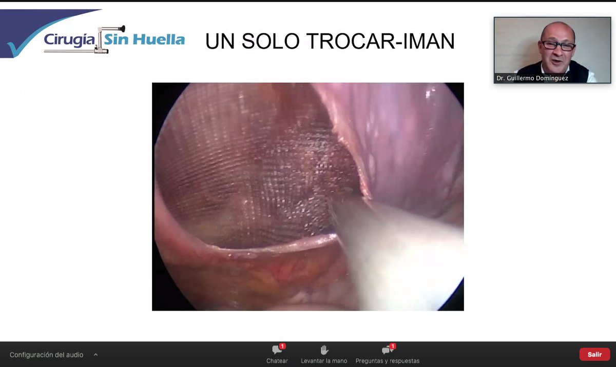 HubSurgery's tweet photo. “Cuando hay un lipoma, no debemos de perder de vista que siempre puede haber otro”.
Demostración del Dr. Guillermo Domínguez de una hernioplastia #TAPP con un solo trocar y con asistencia de imán.
#thesurgeryhub #hernioplastia #laparoscopia #minilap #cirugiasegura https://t.co/ZTFNCclwTA