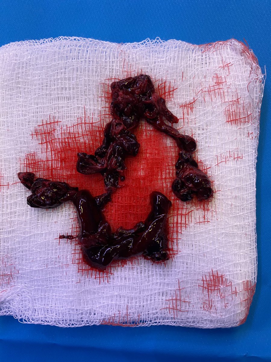 Kellan Ashley (@kellanashleymd) on Twitter photo COVID +, unvaccinated patientāpresented with high risk submassive PE related to COVID. Great, quick action by <a href="/UMMCnews/">The University of Mississippi Medical Center</a> evolving #PERT . We performed pulmonary embolectomy today with improving status. Please #MaskUp #VaxUp MS!! <a href="/UMMC_Heart/">University Heart at UMMC</a> <a href="/GHernandezMD/">Gabriel A Hernandez MD FACC FSCAI</a> <a href="/Drbrewerinms/">Michael Brewer</a> @jgeoharv COVID +, unvaccinated patientāpresented with high risk submassive PE related to COVID. Great, quick action by <a href="/UMMCnews/">The University of Mississippi Medical Center</a> evolving #PERT . We performed pulmonary embolectomy today with improving status. Please #MaskUp #VaxUp MS!! <a href="/UMMC_Heart/">University Heart at UMMC</a> <a href="/GHernandezMD/">Gabriel A Hernandez MD FACC FSCAI</a> <a href="/Drbrewerinms/">Michael Brewer</a> @jgeoharv