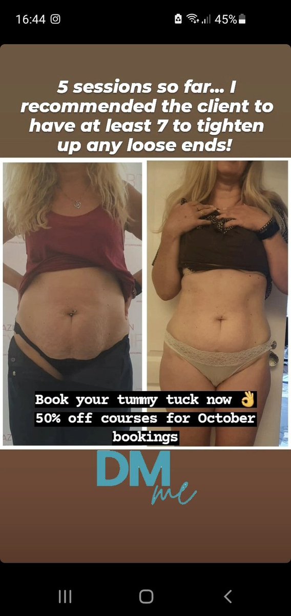 #bodycontouring #fatdissolving #bellyfat #cellulite #tummytuck #brazilianbuttlift #fatreduction #skintightening #cellulitereduction #essex #bodysculpting #bodytransformation #flatstomach #hertfordshire #aesthetics #selfcare #FYP #LoveIslandUK #bodycontour #tummytuck