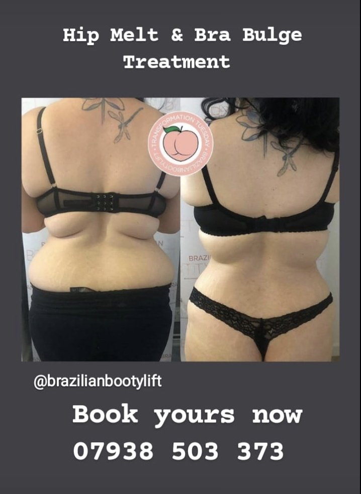 #bodycontouring #fatdissolving #bellyfat #cellulite #tummytuck #walthamabbey #brazilianbuttlift #fatreduction #skintightening #cellulitereduction #essex #bodysculpting #bodytransformation #flatstomach #hertfordshire #aesthetics #selfcare #FYP #LoveIslandUK #bodycontour