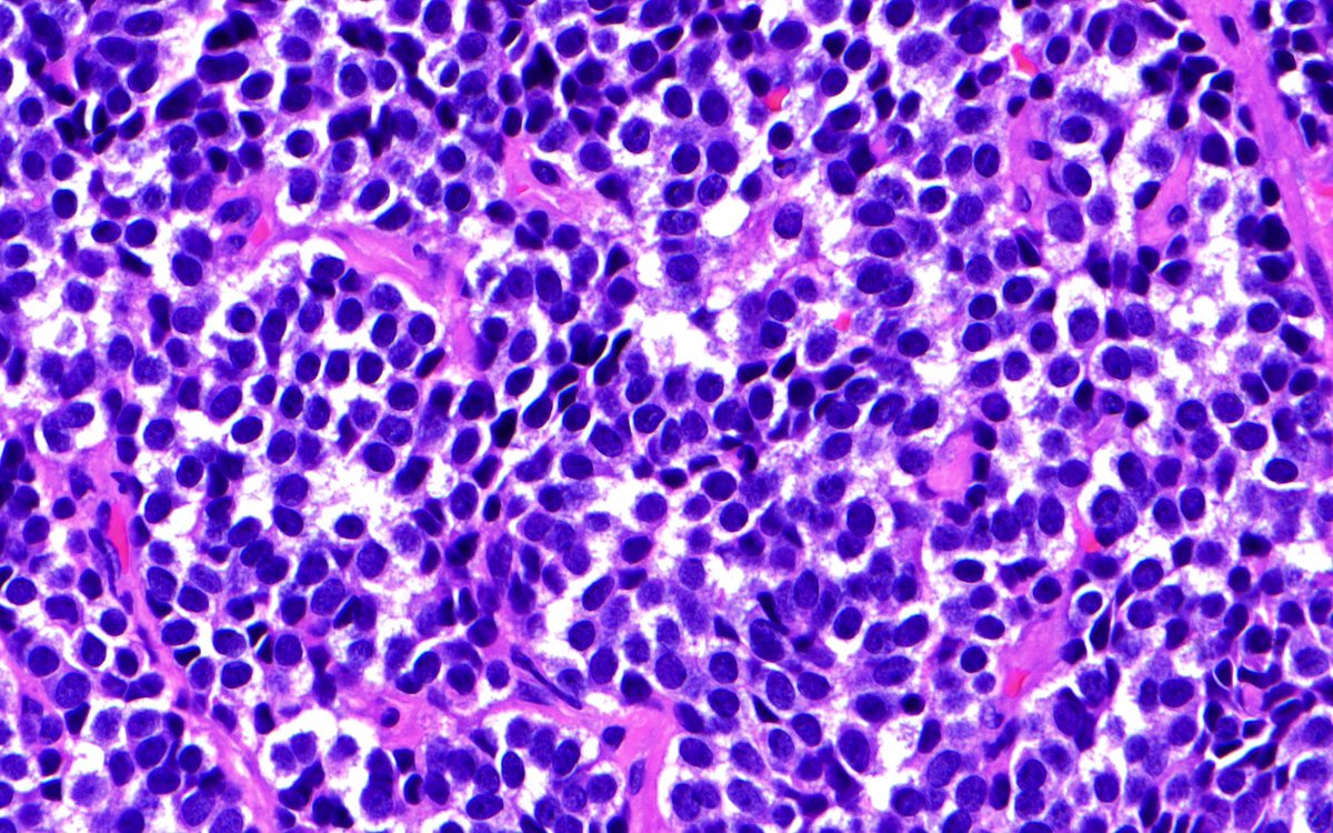 bitar_mireille's tweet photo. #tumor resection of a clinically non-functioning #pituitaryadenoma, H&E and #immunostains (IHCs), likely diagnosis? #PathTwitter #endocrinepath #brainmass #neuropath #pathology #histology #Neurosurgery #meded #endocrinology @NU_Pathology @PJamshidi_MD @DGNN_eV @neuropathology https://t.co/JQyZGL1Nei