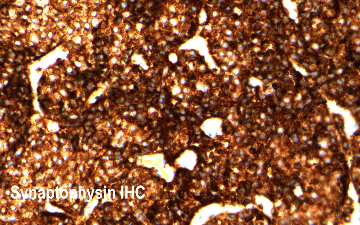 bitar_mireille's tweet photo. #tumor resection of a clinically non-functioning #pituitaryadenoma, H&E and #immunostains (IHCs), likely diagnosis? #PathTwitter #endocrinepath #brainmass #neuropath #pathology #histology #Neurosurgery #meded #endocrinology @NU_Pathology @PJamshidi_MD @DGNN_eV @neuropathology https://t.co/JQyZGL1Nei