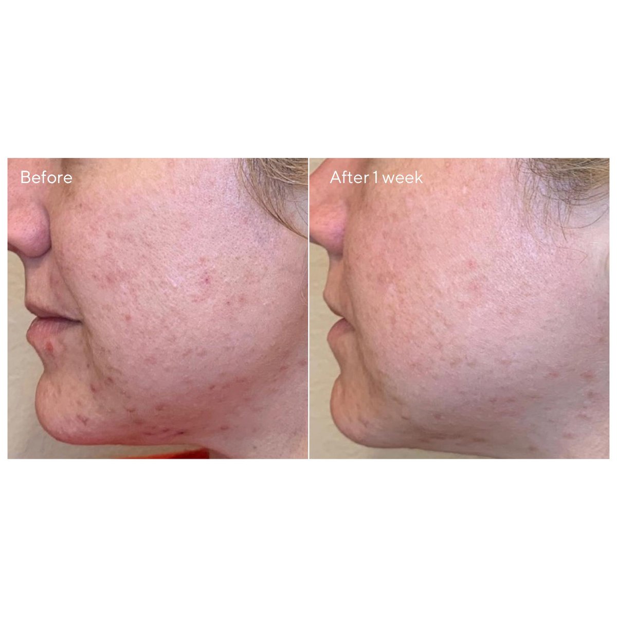 Ready to clear and smooth skin in ONE ☝️ step? Introducing your new skin savior: NEW Daily Clarifying Peel.