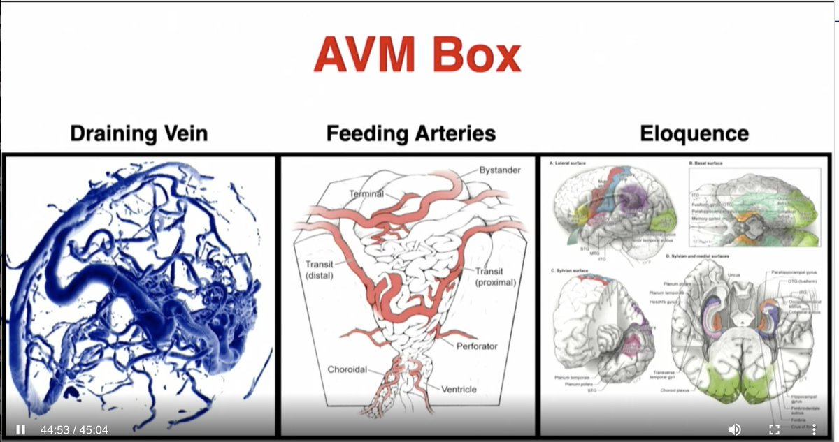 JNIS (@jnis_bmj) on Twitter photo Dr. <a href="/mtlawton/">Michael T. Lawton, MD</a> giving us the open surgical perspective of AVM resection. Decision making is key. Which AVMs need/ deserve intervention? #SNIS2021 #NeuroIRTip
<a href="/GuenegoAdrien/">The French Brain Doctor</a> <a href="/lila_sheikhi/">Lila Sheikhi, MD</a> <a href="/DanniDiestro/">Dr. DiestroKE</a> <a href="/JNIS_BMJ/">JNIS</a> <a href="/esmintsociety/">ESMINT Society</a>
<a href="/SNISinfo/">SNIS Info</a> <a href="/fcalbuquerque51/">Felipe C. Albuquerque</a> <a href="/aggiemarie93/">Marie Williams Denslow</a> <a href="/rdeleacymd/">Reade De Leacy MD</a> Dr. <a href="/mtlawton/">Michael T. Lawton, MD</a> giving us the open surgical perspective of AVM resection. Decision making is key. Which AVMs need/ deserve intervention? #SNIS2021 #NeuroIRTip
<a href="/GuenegoAdrien/">The French Brain Doctor</a> <a href="/lila_sheikhi/">Lila Sheikhi, MD</a> <a href="/DanniDiestro/">Dr. DiestroKE</a> <a href="/JNIS_BMJ/">JNIS</a> <a href="/esmintsociety/">ESMINT Society</a>
<a href="/SNISinfo/">SNIS Info</a> <a href="/fcalbuquerque51/">Felipe C. Albuquerque</a> <a href="/aggiemarie93/">Marie Williams Denslow</a> <a href="/rdeleacymd/">Reade De Leacy MD</a>