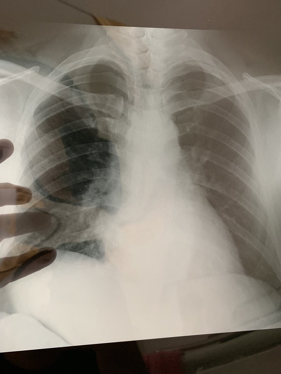 “Heatmaps” covid di paru2 admin (ga ngeroko). Teman2 harus lebih berhati2 lagi krn defend rapat pun jebol. Rontgent ini 3 hari setelah muncul gejala. Mohon maaf jarang update skr dirawat &amp; fokus di kesembuhan.