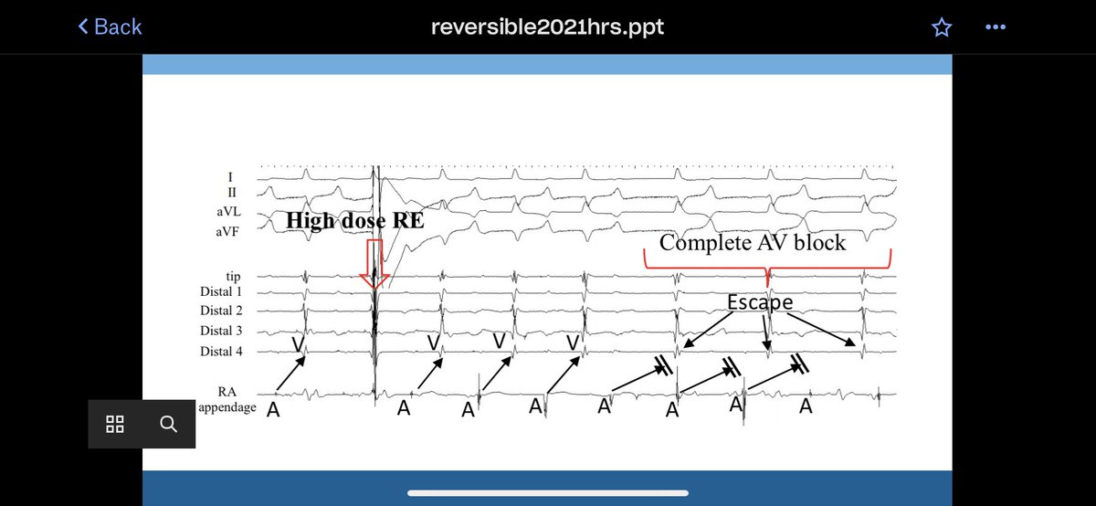 Dose dependent reversible electroporation -  effect on AV node conduction.  Follow up from last years data on egm amplitude - transient AV block after the pulse that reverses in &lt;1-2 minutes