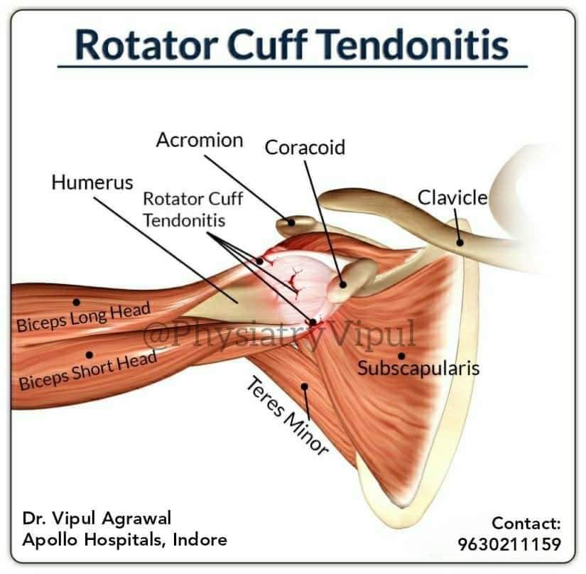 PhysiatryVipul's tweet photo. Treatment for one of the most common painful condition of the shoulder, #rotatorcufftendonitis, depends on medications, exercises, and #interventional #painrelief procedures like joint injections/#nerveblocks.
#musculoskeletal #Apollo #PMR

#PhysiatryVipul #Indore #Rehabilitation https://t.co/Ww9CUXM2ZT