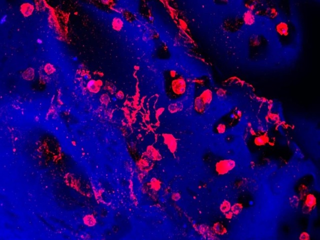 BPoD_s's tweet photo. Lab bone marrow model grown from patient #cells successfully tests how the individual will respond to #platelets-boosting treatments. Image and research by Christian A Di Buduo et al @ABalduiniLab @unipv in @eLife. Read more on https://t.co/2nV5sXmstL with @MRC_LMS and @esbriolat https://t.co/5ijpEUzxMd